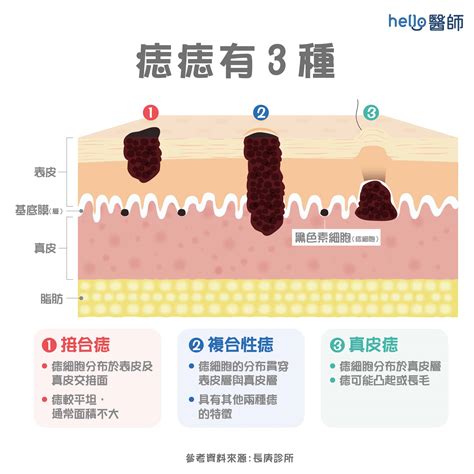 痣的形成